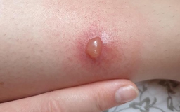 Vết bóng nước do côn trùng đốt bị vỡ, chăm sóc thế nào?