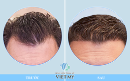 Cấy tóc thẩm mỹ bằng robot ứng dụng AI