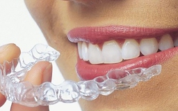 Niềng răng Invisalign: Hành trình ‘lột xác’ nụ cười cùng Nha khoa quốc tế Phú Hòa