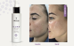 Review serum Image Iluma Intense Facial Illuminator có hiệu quả trị nám trong 4 tuần không?