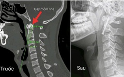 Phẫu thuật nội soi điều trị thành công ca gãy cột sống cổ phức tạp