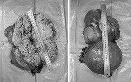 Bụng to như có song thai, đi khám phát hiện khối u tử cung 8 kg