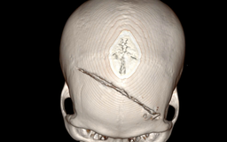 Vỡ sọ, dập não sau xô xát, nam thanh niên được cứu sống đầy ngoạn mục