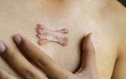 [Review nhanh] Top 5 cách trị sẹo lồi đang được thực hiện nhiều hiện nay