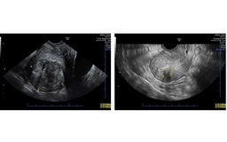 Điều trị u tử cung không xâm lấn, bảo tồn chức năng sinh sản