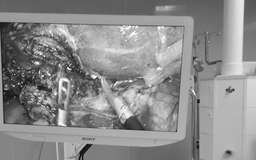 Cứu sống bệnh nhân rò túi mật - tá tràng kèm sỏi ống mật chủ hiếm gặp