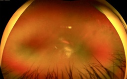 Tầm soát miễn phí bệnh võng mạc cho người bệnh đái tháo đường bằng công nghệ AI