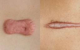 Scar FX & Rejuvasil khác gì so với các giải pháp chăm sóc sẹo thông thường?