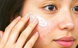 Tạm biệt sẹo rỗ, 5 bí kíp chăm sóc da phục hồi da sau mụn hiệu quả