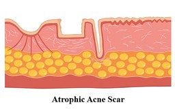 Sẹo mụn hình thành như thế nào? Hiểu nguyên nhân nắm rõ cách xóa sẹo hiệu quả