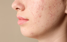 Vì sao Scar Esthetique là sản phẩm dành cho thâm đỏ sau mụn? 