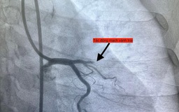 1 ngày 4 ca nhồi máu cơ tim cấp nhập viện, có bất thường?