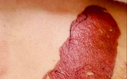 Dán cao trị u vú khiến da phồng rộp, đi khám phát hiện ung thư