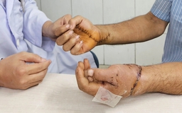 Bệnh viện Chợ Rẫy 'báo động đỏ’, 12 giờ nối 2 tay đứt lìa cho bệnh nhân