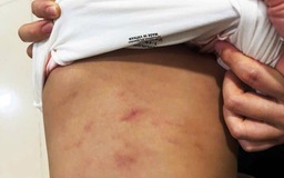 Cà Mau: Đề nghị công an điều tra trẻ 2 tuổi nghi bị bạo hành