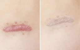 Những điều bạn cần biết trước khi chăm sóc sẹo lồi/phì đại