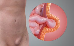 Người đàn ông 51 tuổi suýt gặp biến chứng nguy hiểm vì khối phồng vùng bẹn