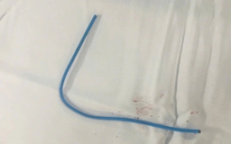 Bệnh viện Quân y 175 tiếp nhận ca bệnh bị dị vật kẹt trong tim hiếm gặp