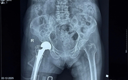 Thay khớp háng thành công cho cụ bà 100 tuổi