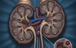 Suy thận tăng vào mùa đông: Bác sĩ chỉ cách phòng bệnh