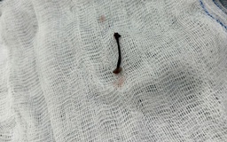 Tắm suối, bé trai 30 tháng tuổi bị vắt chui vào mũi