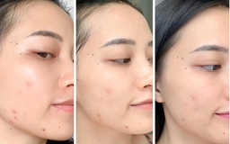 Chấm dứt nỗi lo da bị thâm mụn trong 4 tuần, da trắng sáng đều màu