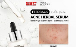 Review serum White Doctors Acne Herbal Serum có thật sự trị mụn dứt điểm trong 4 tuần?