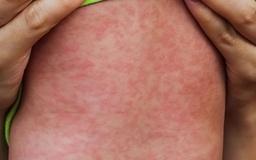 Cảnh báo nhóm nguy cơ cao bị biến chứng nặng do sởi