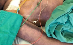 Sau bữa lòng lợn, người đàn ông nguy kịch do nhiễm liên cầu lợn