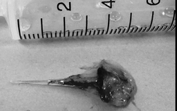 Ho nhiều ngày, đi khám phát hiện xương cá dài 6 cm trong phế quản