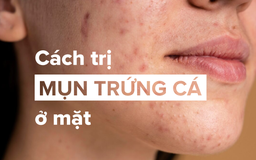 Chi tiết cách trị mụn trứng cá hiệu quả ngay tại nhà từ thể nhẹ tới nặng Chi tiết cách trị mụn trứng cá hiệu quả ngay tại nhà từ thể nhẹ tới nặng