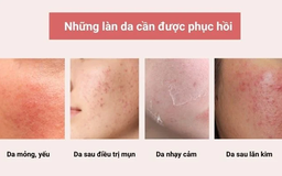 Khi nào làn da cần phục hồi?