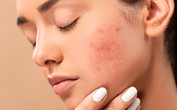 Da kích ứng vì thời tiết - Phục hồi như thế nào?