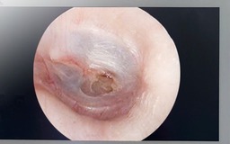 Lặn biển ngắm san hô, người phụ nữ bị thủng màng nhĩ