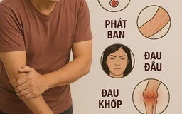 Virus chikungunya gây bệnh 'người đi khom lưng'