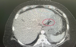 Suýt mất mạng do mảnh xương cá đâm thủng dạ dày