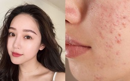 Top 10 kem chống nắng cho da mụn thông thoáng, không bóng nhờn, ngừa mụn hiệu quả