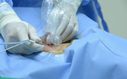 Đột phá mới trong điều trị hạch cổ tái phát sau ung thư tuyến giáp
