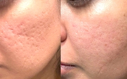 Nguyên tắc vàng trong chăm sóc sẹo: Điều mà nhiều người Việt đang bỏ qua