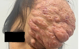 Cô gái Sơn La mang khối u sọ 15 năm được mổ thành công ở Bình Dương