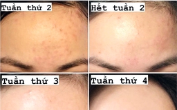 [Review] Top 4 kem giảm mụn ẩn hiệu quả, ngừa sẹo tối đa cho da láng mịn