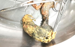 Hy hữu: Búi tóc dài 12 cm trong ruột bé gái 4 tuổi