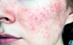 Mùa thu giao mùa - thời điểm dễ tổn thương nhất của làn da nhạy cảm