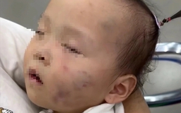 Tạm giữ bảo mẫu vụ bé gái 15 tháng tuổi có nhiều vết bầm tím