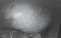 Đau bụng âm ỉ, nhập viện bác sĩ phát hiện khối u buồng trứng lớn