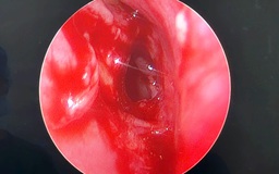 Hiếm gặp: Cụ ông mất hoàn toàn thị lực mắt trái vì khối u nhầy xoang bướm