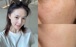 Top 3 serum tranexamic acid giúp mờ nám sạm sau 4 tuần dù chân sâu, lâu năm