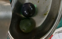 Tưởng hạt nở là thạch, bé 1 tuổi tắc ruột phải mổ cấp cứu