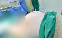 Phẫu thuật cắt tử cung vì khối u xơ khổng lồ nặng hơn 4 kg