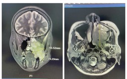 Đau hàm, nghẹt mũi, chảy máu răng - Đi khám phát hiện ung thư xoang